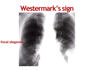 Watermark Sign Radiology Pulmonary embolism | PPTX