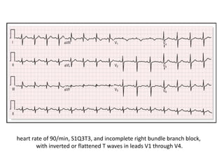 heart rate of 90/min, S1Q3T3, and incomplete right bundle branch block,
with inverted or flattened T waves in leads V1 through V4.
 