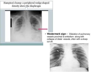 Pulmonary Embolism | PPTX