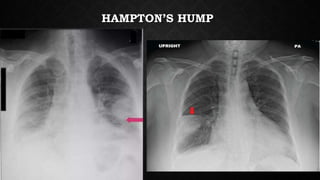 HAMPTON’S HUMP
 