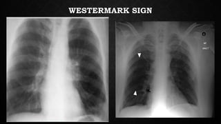 WESTERMARK SIGN
 