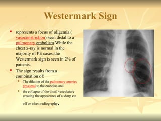 Westermark Sign
 represents a focus of oligemia (
vasoconstriction) seen distal to a
pulmonary embolism.While the
chest x-ray is normal in the
majority of PE cases, the
Westermark sign is seen in 2% of
patients.
 The sign results from a
combination of:
 The dilation of the pulmonary arteries
proximal to the embolus and
 the collapse of the distal vasculature
creating the appearance of a sharp cut
off on chest radiography.
 