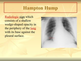 Hampton Hump
Radiologic sign which
consists of a shallow
wedge-shaped opacity in
the periphery of the lung
with its base against the
pleural surface.
 
