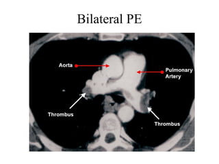 Bilateral PE
 