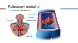 Pulmonary embolism
 