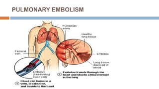 PULMONARY EMBOLISM
 