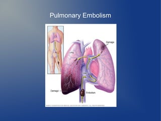 Pulmonary Embolism
 
