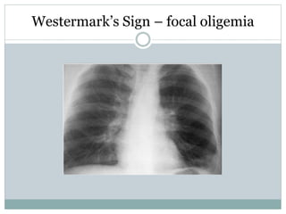 Westermark’s Sign – focal oligemia
 