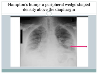 Hampton’s hump- a peripheral wedge shaped
density above the diaphragm
 