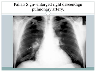Palla’s Sign- enlarged right descendign
pulmonary artery.
 