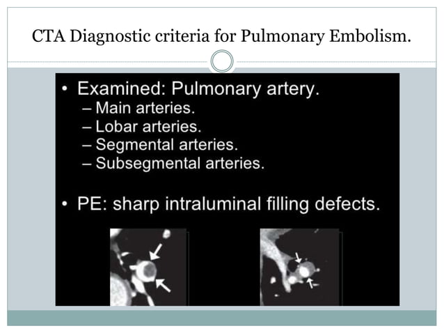 Positive Pe Study Pulmonary embolism radiology | PPTX