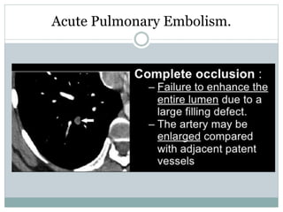 Acute Pulmonary Embolism.
 
