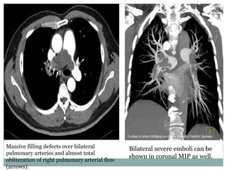 Massive filling defects over bilateral
pulmonary arteries and almost total
obliteration of right pulmonary arterial flow
(arrows).
Bilateral severe emboli can be
shown in coronal MIP as well.
 