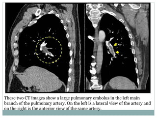These two CT images show a large pulmonary embolus in the left main
branch of the pulmonary artery. On the left is a lateral view of the artery and
on the right is the anterior view of the same artery.
 