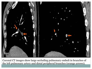 Coronal CT images show large occluding pulmonary emboli in branches of
the left pulmonary artery and distal peripheral branches (orange arrows).
 