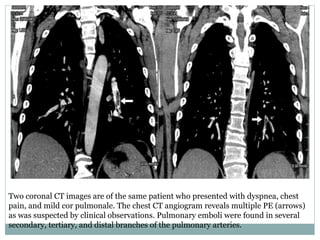 Two coronal CT images are of the same patient who presented with dyspnea, chest
pain, and mild cor pulmonale. The chest CT angiogram reveals multiple PE (arrows)
as was suspected by clinical observations. Pulmonary emboli were found in several
secondary, tertiary, and distal branches of the pulmonary arteries.
 