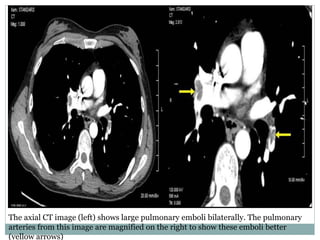The axial CT image (left) shows large pulmonary emboli bilaterally. The pulmonary
arteries from this image are magnified on the right to show these emboli better
(yellow arrows)
 