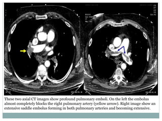These two axial CT images show profound pulmonary emboli. On the left the embolus
almost completely blocks the right pulmonary artery (yellow arrow). Right image show an
extensive saddle embolus forming in both pulmonary arteries and becoming extensive.
 