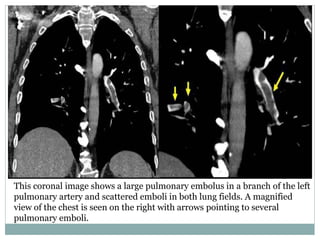 This coronal image shows a large pulmonary embolus in a branch of the left
pulmonary artery and scattered emboli in both lung fields. A magnified
view of the chest is seen on the right with arrows pointing to several
pulmonary emboli.
 
