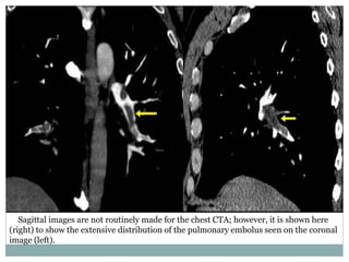 Sagittal images are not routinely made for the chest CTA; however, it is shown here
(right) to show the extensive distribution of the pulmonary embolus seen on the coronal
image (left).
 