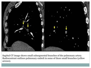 Sagittal CT image shows small subsegmental branches of the pulmonary artery.
Radiocontrast outlines pulmonary emboli in some of these small branches (yellow
arrows).
 