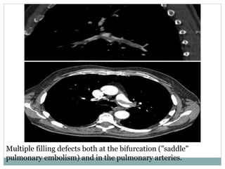 Multiple filling defects both at the bifurcation ("saddle"
pulmonary embolism) and in the pulmonary arteries.
 