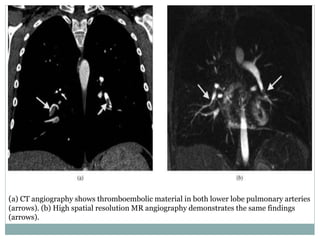 (a) CT angiography shows thromboembolic material in both lower lobe pulmonary arteries
(arrows). (b) High spatial resolution MR angiography demonstrates the same findings
(arrows).
 