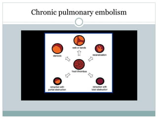 Chronic pulmonary embolism
 