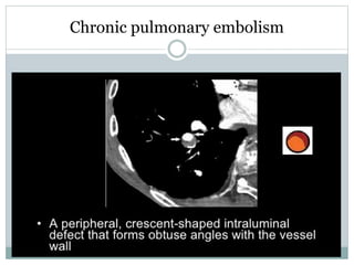 Chronic pulmonary embolism
 