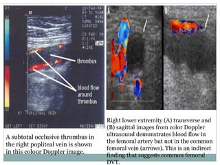 A subtotal occlusive thrombus in
the right popliteal vein is shown
in this colour Doppler image.
Right lower extremity (A) transverse and
(B) sagittal images from color Doppler
ultrasound demonstrates blood flow in
the femoral artery but not in the common
femoral vein (arrows). This is an indirect
finding that suggests common femoral
DVT.
 