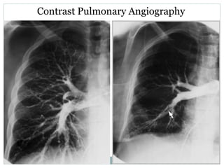Contrast Pulmonary Angiography
 