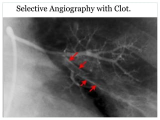 Selective Angiography with Clot.
 