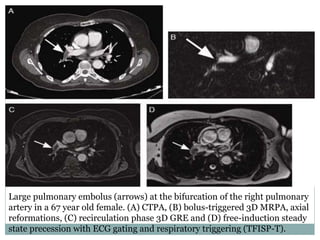 Large pulmonary embolus (arrows) at the bifurcation of the right pulmonary
artery in a 67 year old female. (A) CTPA, (B) bolus-triggered 3D MRPA, axial
reformations, (C) recirculation phase 3D GRE and (D) free-induction steady
state precession with ECG gating and respiratory triggering (TFISP-T).
 
