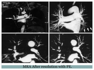 MRA After resolution with PE.
 