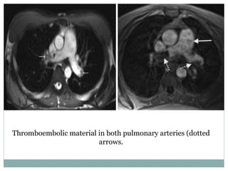 Thromboembolic material in both pulmonary arteries (dotted
arrows.
 