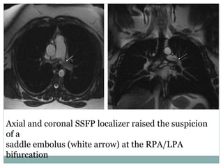 Axial and coronal SSFP localizer raised the suspicion
of a
saddle embolus (white arrow) at the RPA/LPA
bifurcation
 