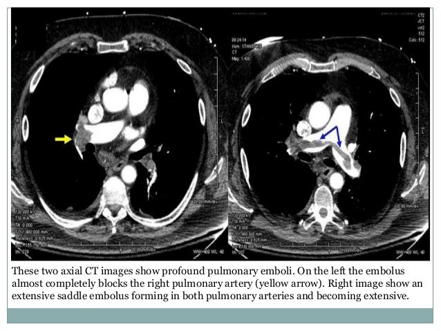 Pulmonary embolism radiology