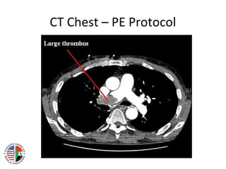 CT Chest – PE Protocol
 