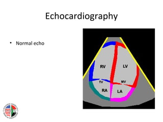 Echocardiography

• Normal echo
 
