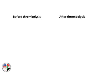 Before thrombolysis   After thrombolysis
 