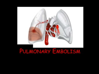 Pulmonary embolism 2