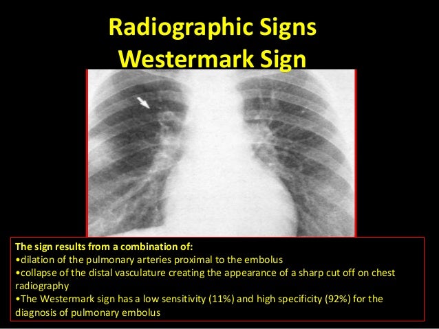 Pulmonary embolism 2