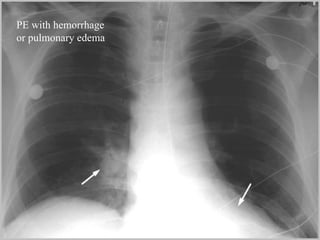 PE with hemorrhage or pulmonary edema 