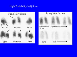 High Probability V/Q Scan 