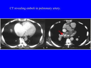 CT revealing emboli in pulmonary artery. 