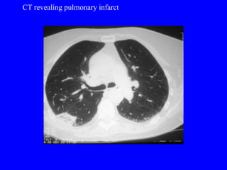 CT revealing pulmonary infarct 