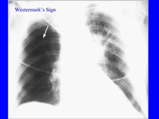 PE Westermark’s Sign 