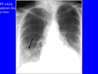 PE which  appears like a mass. 