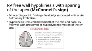 RV free wall hypokinesis with sparing
of the apex (McConnell’s sign)
• Echocardiographic finding classically associated with acute
Pulmonary Embolism.
• Hypokinesis (reduced movement) of the mid and basal RV
free wall with preserved or hyperdynamic motion of the RV
apex.
 