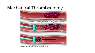 Mechanical Thrombectomy
 